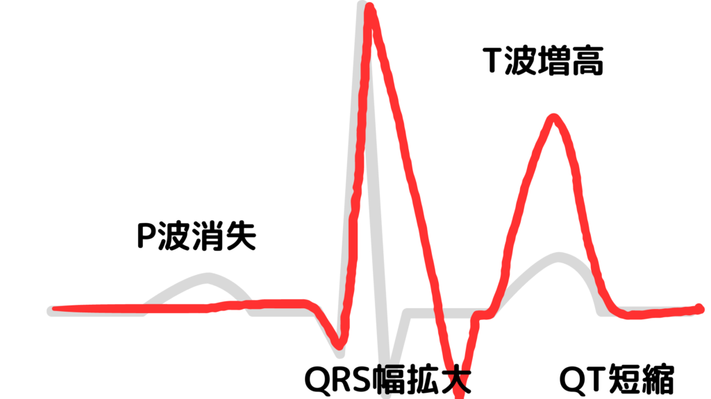 T波増高の心電図