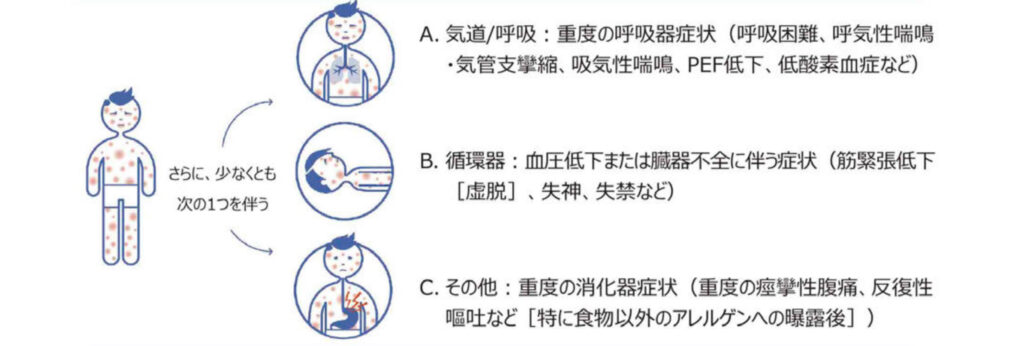 アナフィラキシーを疑うポイント