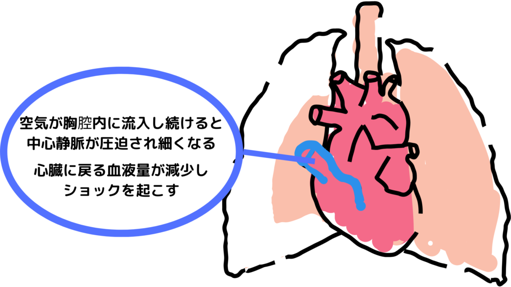 緊張性気胸