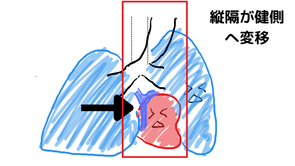 緊張性気胸