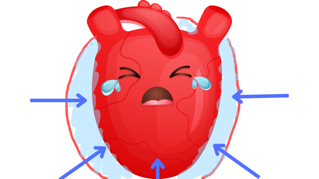心タンポナーデの説明