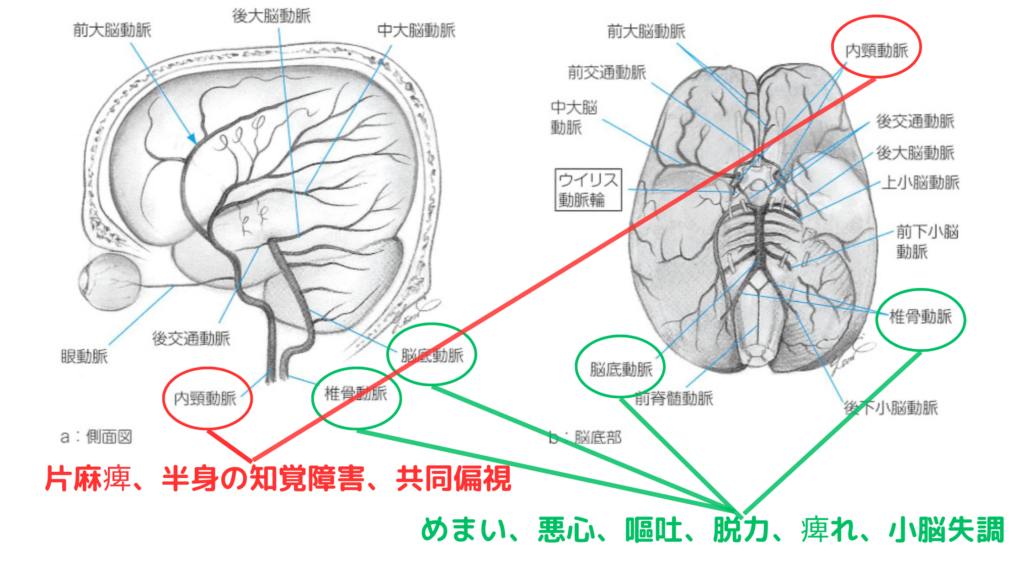 脳梗塞の部位別症状