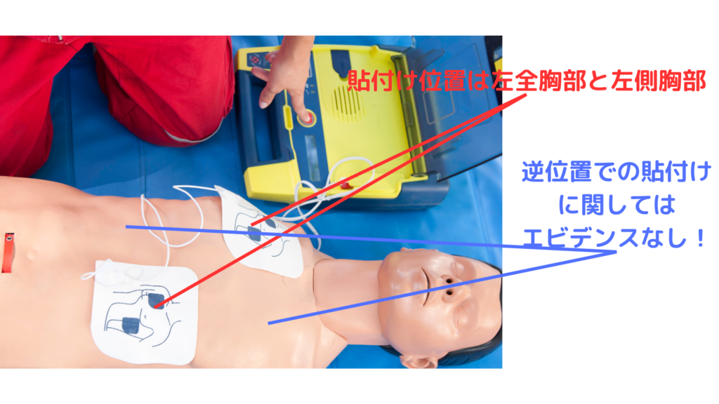 除細動パッド貼付け