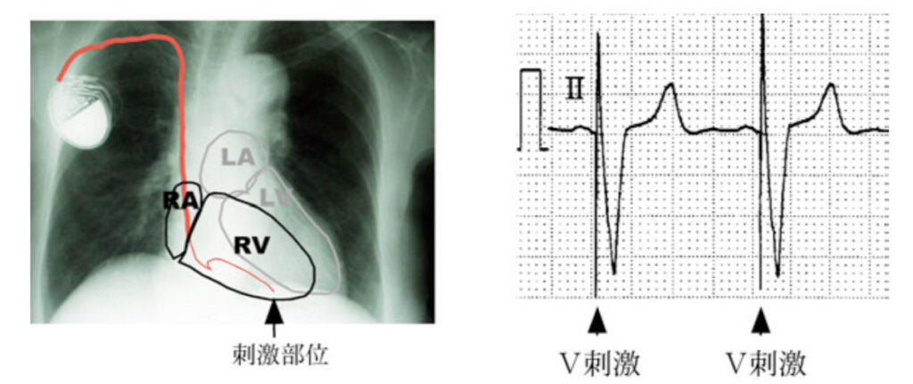 ペースメーカ波形