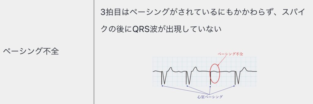 ペーシング不全