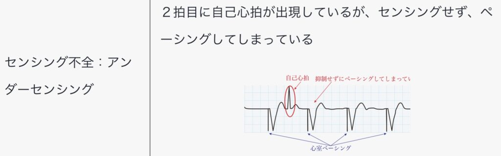 センシング不全/アンダーセンシング