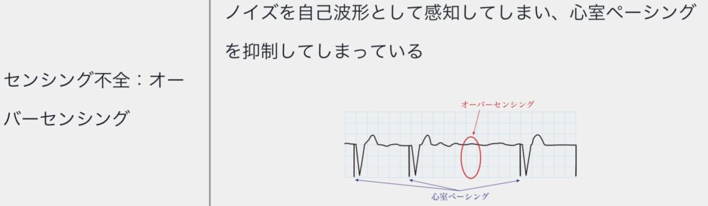 センシング不全（オーバーセンシング）