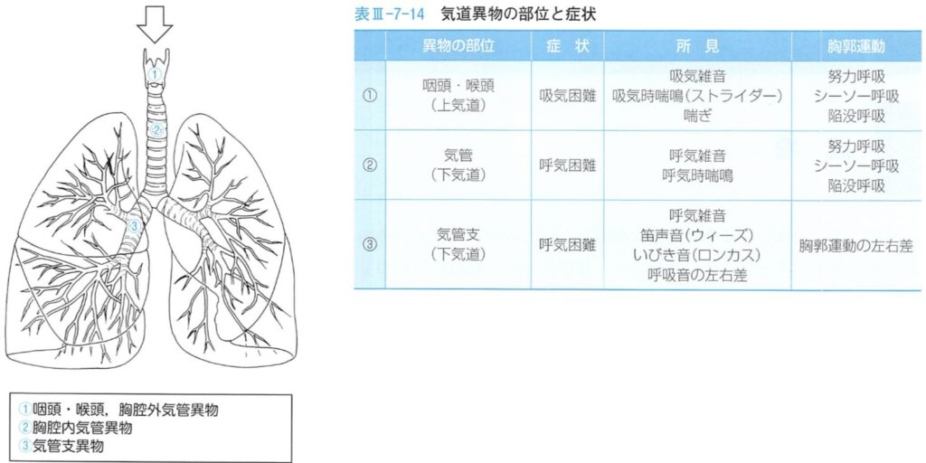 気道異物の部位と症状