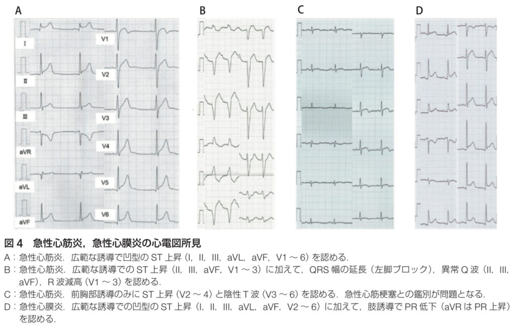 心筋炎の心電図