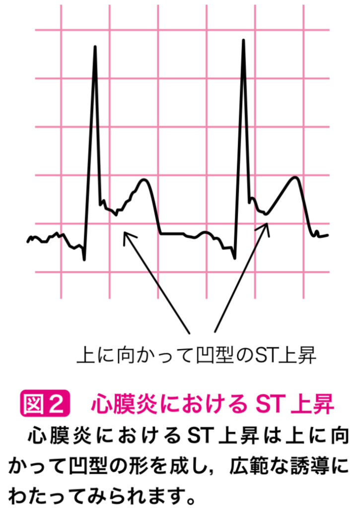 心膜炎の心電図