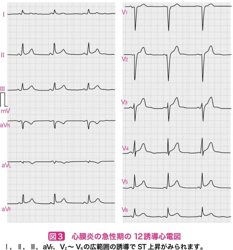 心膜炎の心電図