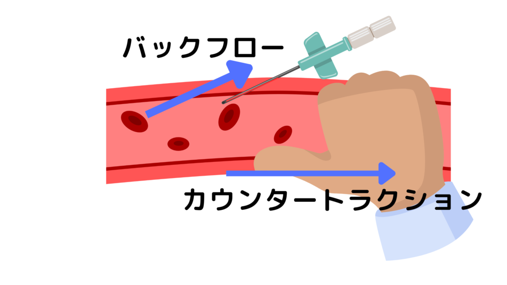 静脈路確保失敗の原因