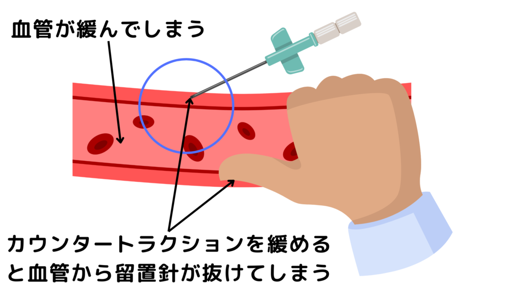 静脈路確保失敗の原因