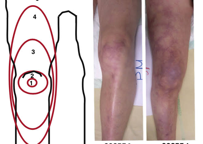 mottling score