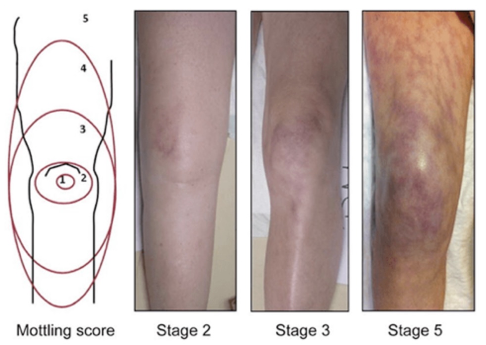 mottling score Stage2-4